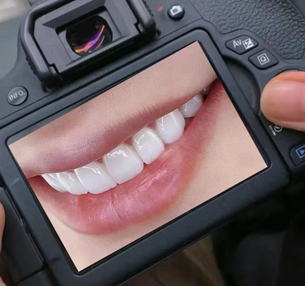 关于牙贴面常见的30个问题