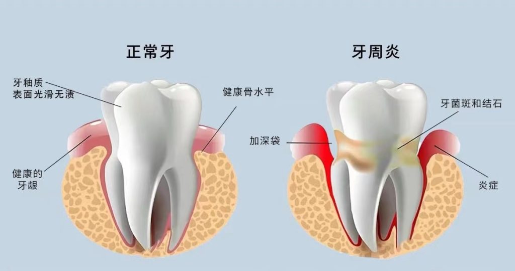 關於牙周炎常見的20個問題？