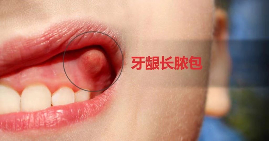 牙龈长出脓包：危险⚠️！不要自己刺破！！